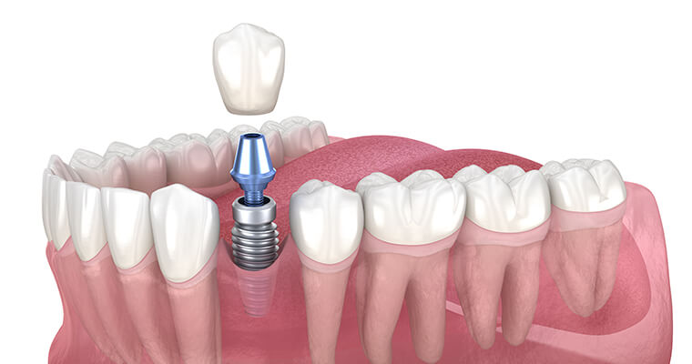 Dental implants at Complete Family Dentistry provide long-lasting solutions to missing or damaged teeth.